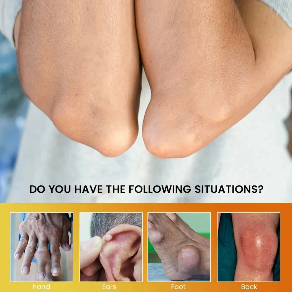 Sumifun Gout Relief Cream – Original